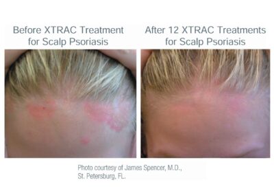 XTRAC_Scalp_Psoriasis