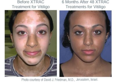 XTRAC_Vitiligo_Adult