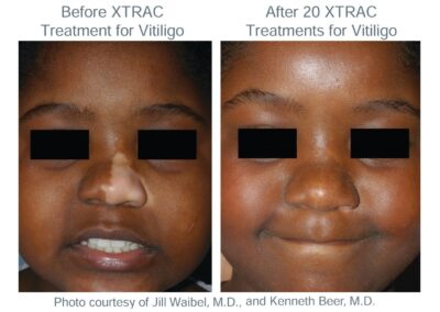XTRAC_Vitiligo_Child