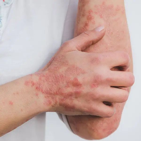 Psoriasis symptoms on a hand and arm.