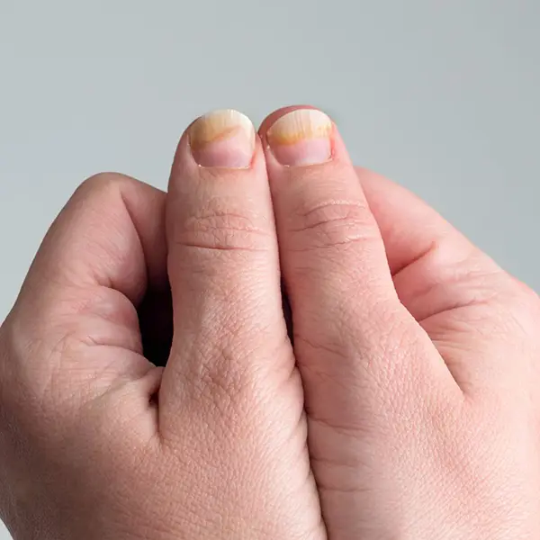 Psoriasis symptoms with discolored nails.