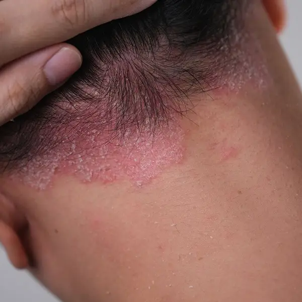 Psoriasis symptoms on the scalp.