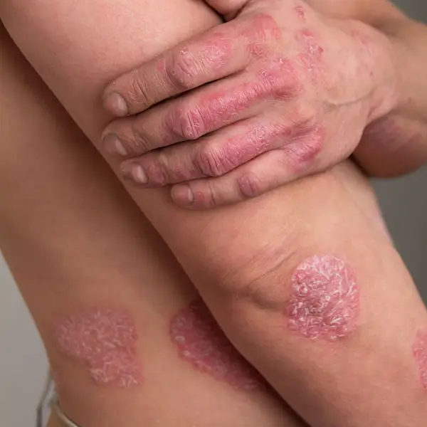 Psoriasis symptoms on the elbow and body.