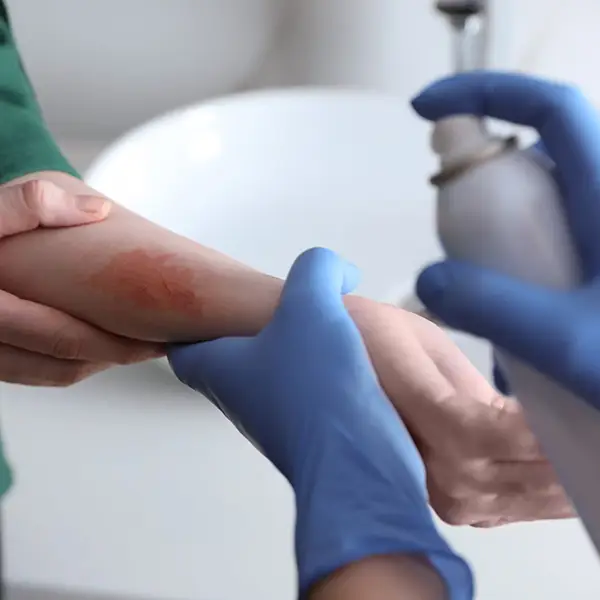 Psoriasis trigger: skin injuries