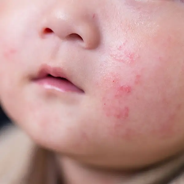 A baby with acne on their cheek.