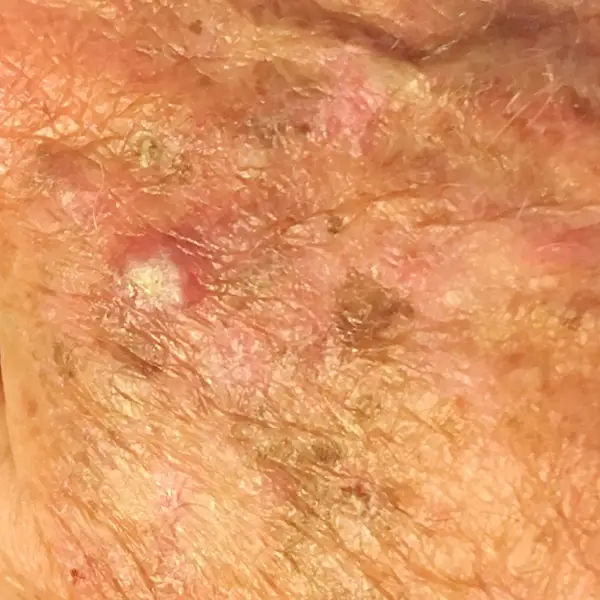 Symptom: Actinic keratoses