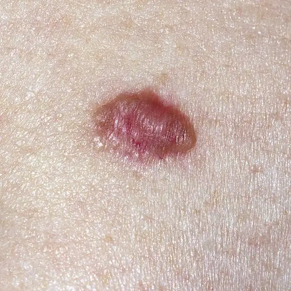 Symptom: Basal cell carcinoma