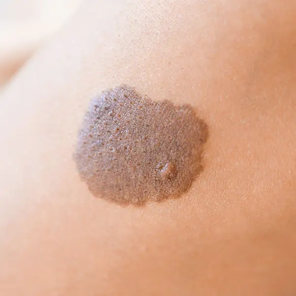 A brown birthmark on an arm.
