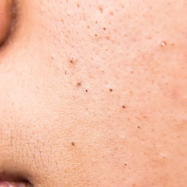 An example of blackheads
