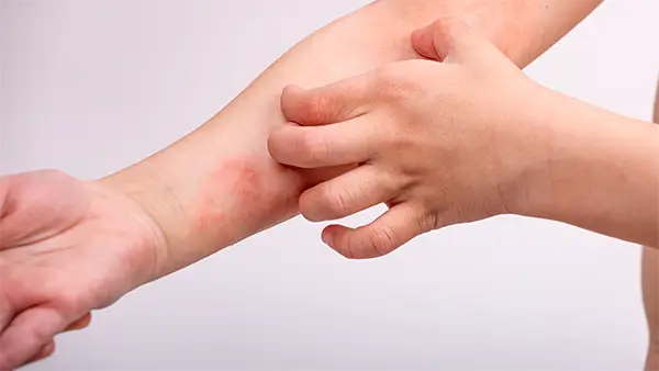 Eczema