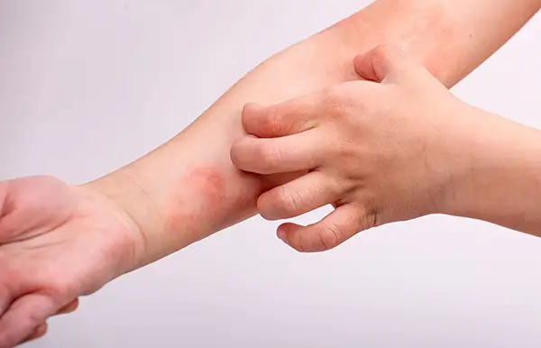 A person scratching a patch of eczema on their arm.