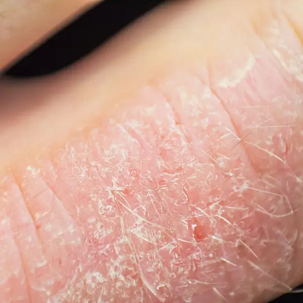 Symptom: Cracked or thickened skin