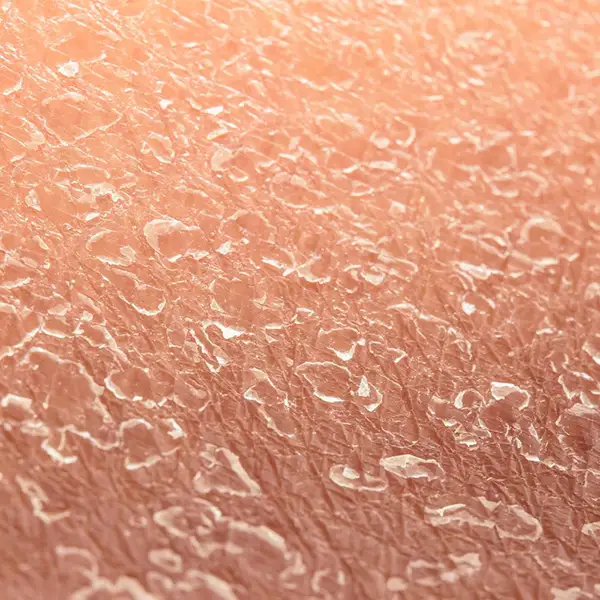 Symptom: Dry, Sensitive Skin