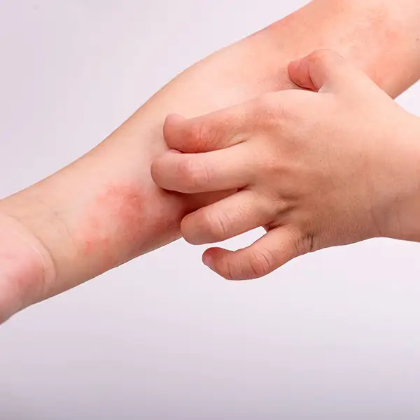A child with Eczema scratching their arm