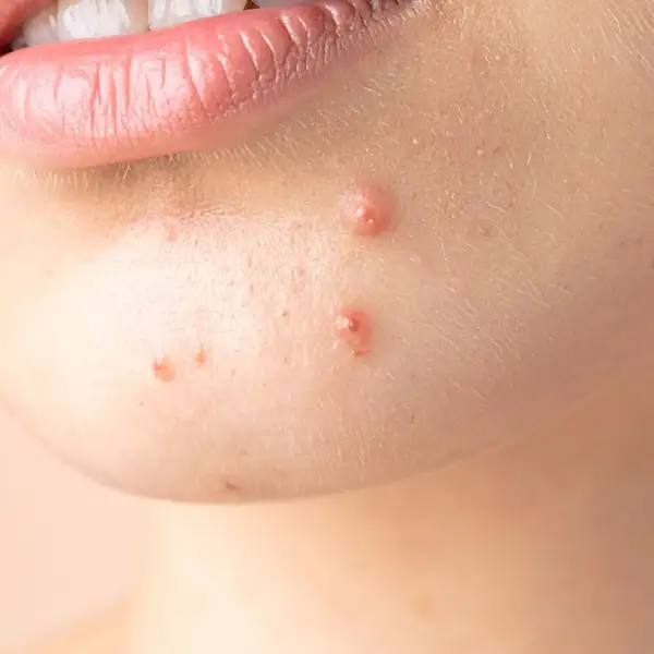 An example of nodules and cysts. 