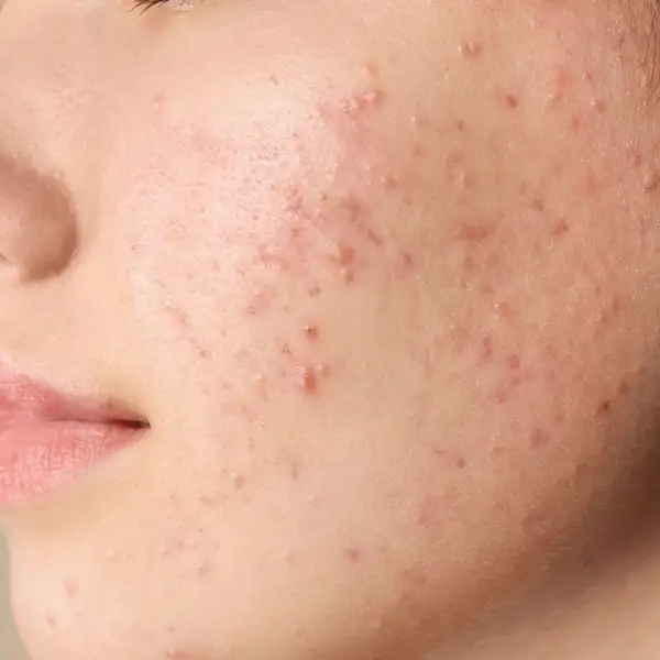 An example of pimples. 