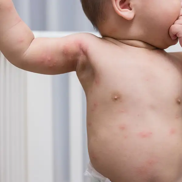 A baby with rashes over their body.