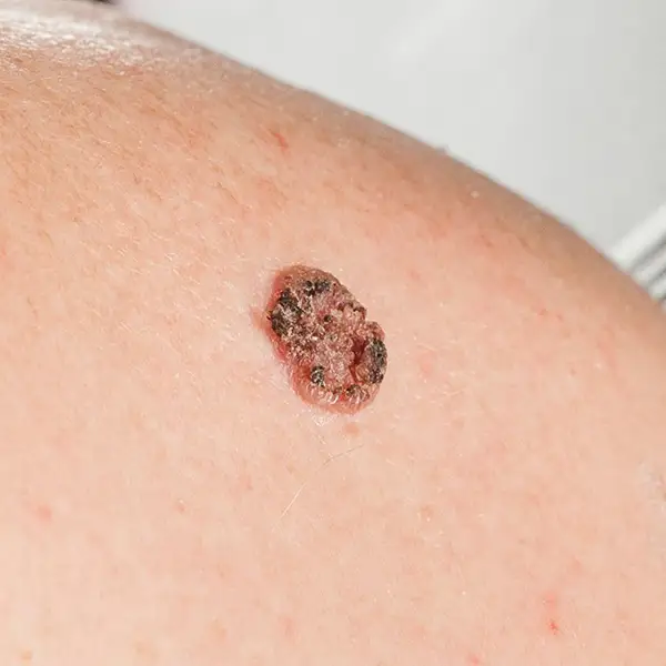 Symptom: Squamous cell carcinoma