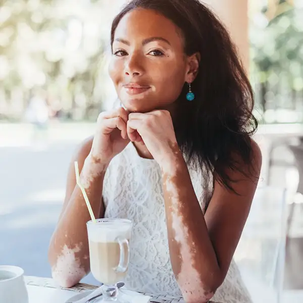 A woman with Vitiligo on her arms.