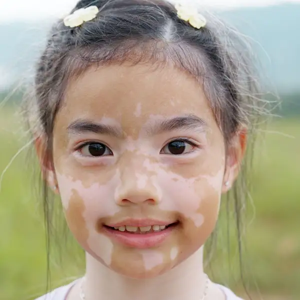 A girl with Vitiligo on her face.