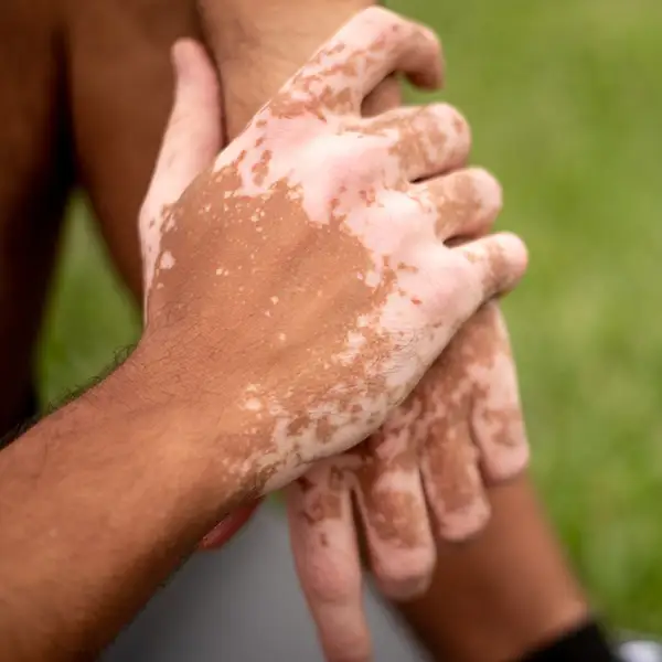 A pair of hands with Vitiligo.