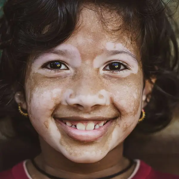A child with Vitiligo on their face.