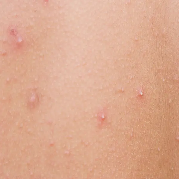 An example of whiteheads